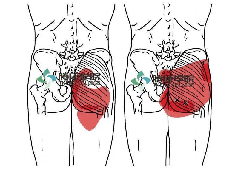 臀大肌拉伤图片