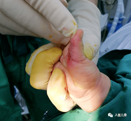 最后,分享今日手术案例儿童扳机指手术可以说是小儿骨科最简单的手术