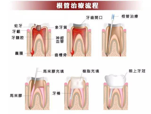 根管治疗全过程示意图