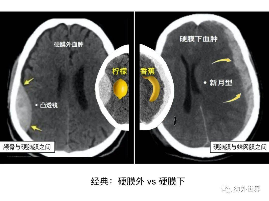 急診頭顱ct-