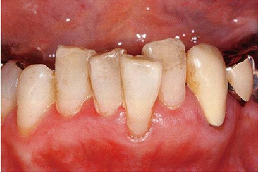 牙周病的分類加病例圖解