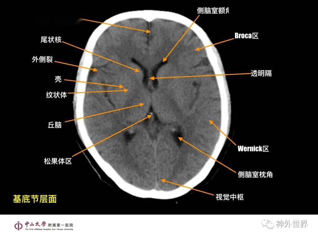 头颅ct扫描基线图解图片