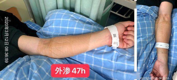 造影劑外滲致整個手臂腫脹這招一次換藥48小時就搞定