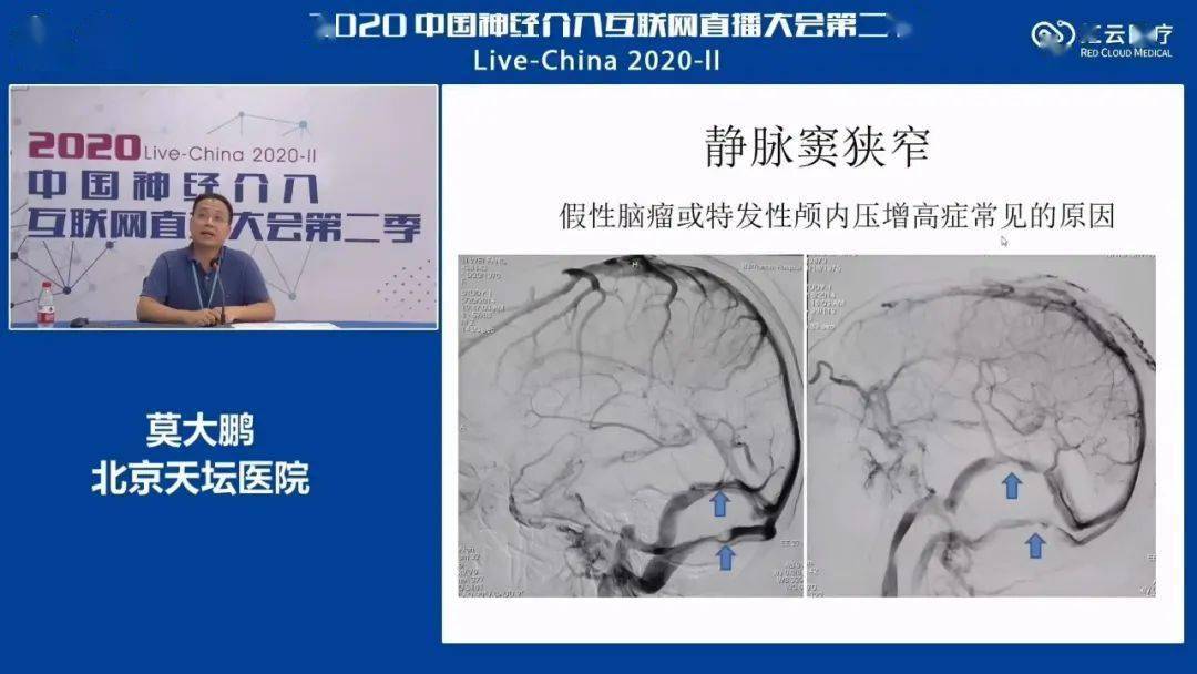 莫大鹏:静脉窦狭窄伴颅内压增高介入治疗的现状与问题