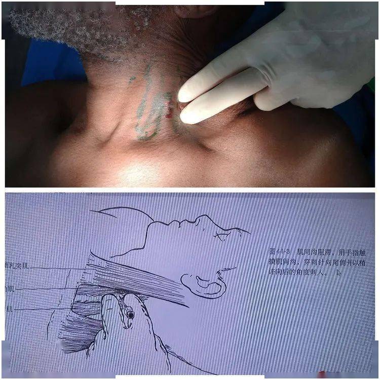 进行颈浅丛,臂丛神经肌间沟入路和腋路的操作,手术有了更多的麻醉选