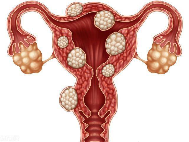 便秘可能诱发子宫肌瘤!中医:教你几招按摩腹部有助改善