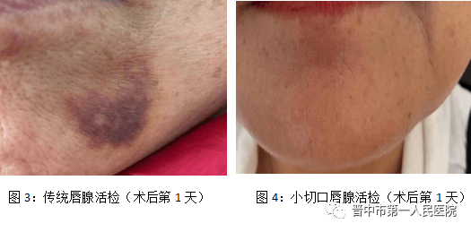 【科室动态】晋中一院风湿免疫科开展小切口唇腺活检_手机搜狐网