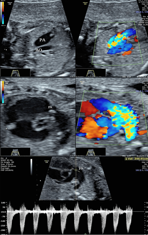 28周做胎儿超声心动图图片