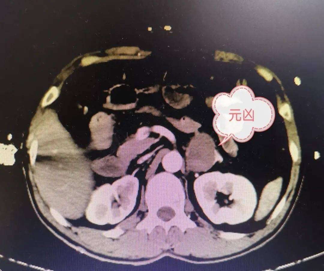 在完善腹部ct后,结果显示:左侧肾上腺增粗,内侧支结节,轻度强化,左侧