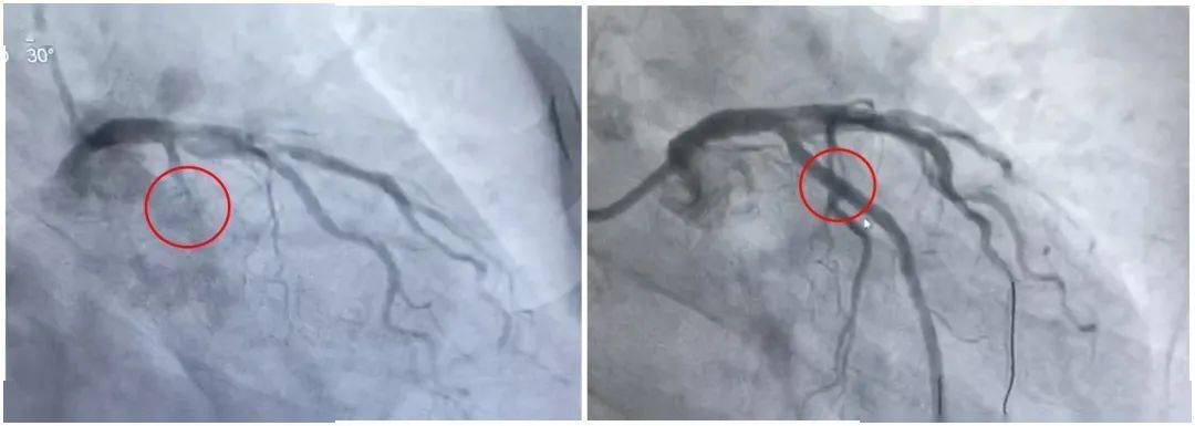 前降支手術前後對比冠狀動脈造影直接反應血管的病變和血流情況,是最