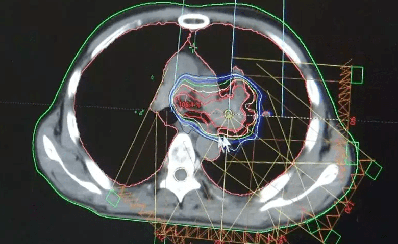 左肺被肿瘤堵死缩成一团,放疗后吐出一块"鱼肉",肺瞬间充满