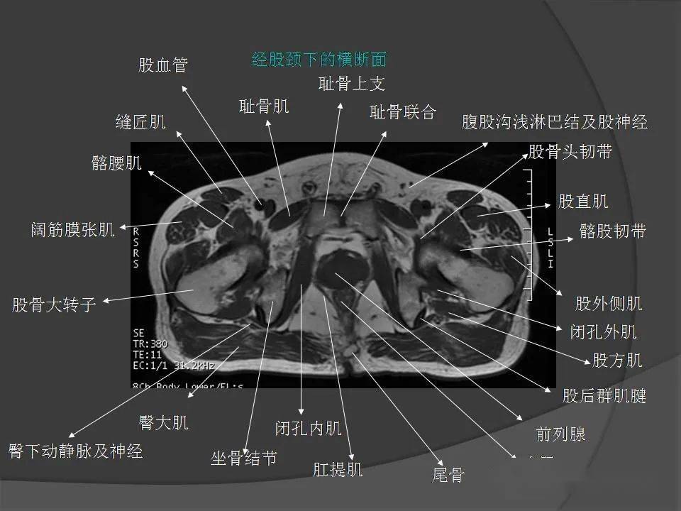 髂腰肌断层解剖图图片