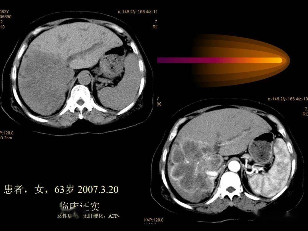 肝内周围型胆管细胞癌的影像特征