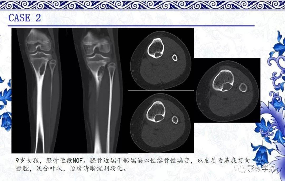 非骨化性纤维瘤CT图片图片