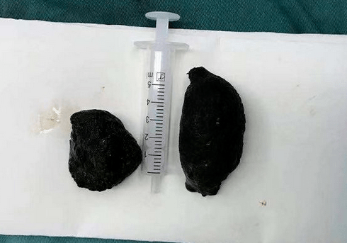 回肠结石约7.0cm×5.0cm