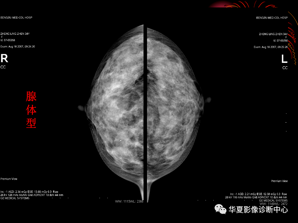 乳腺數字化鉬靶x線診斷的臨床應用