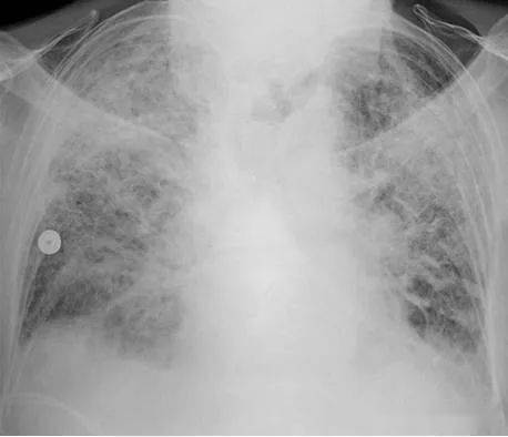 ARDS肺泡图片