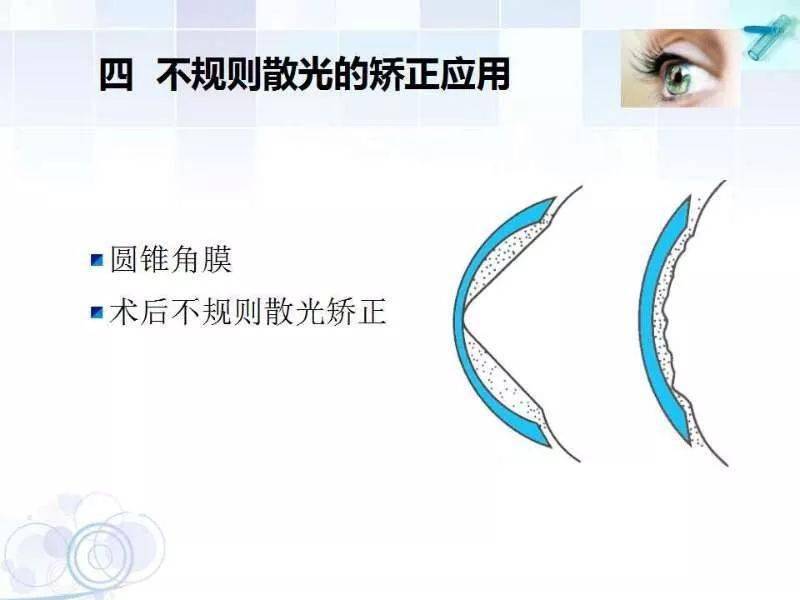 这里主要指圆锥角膜及一些手术后引起的角膜不规则散光.