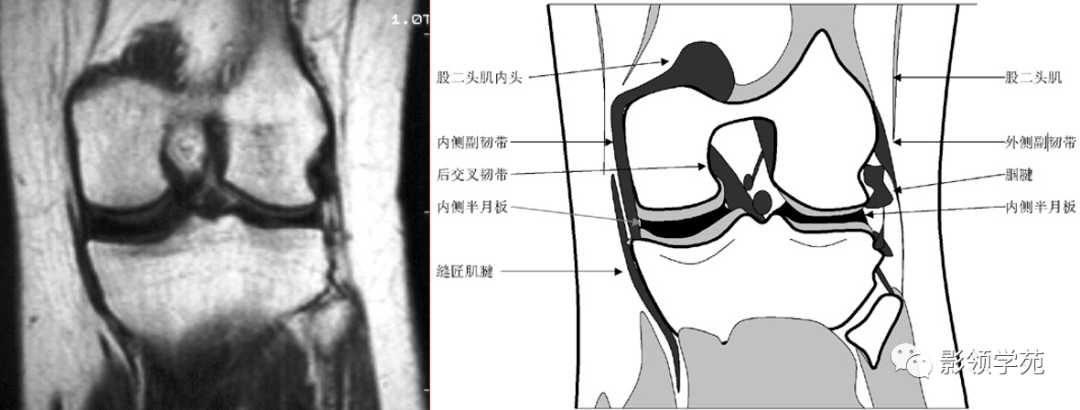 前交叉韧带核磁解剖图图片