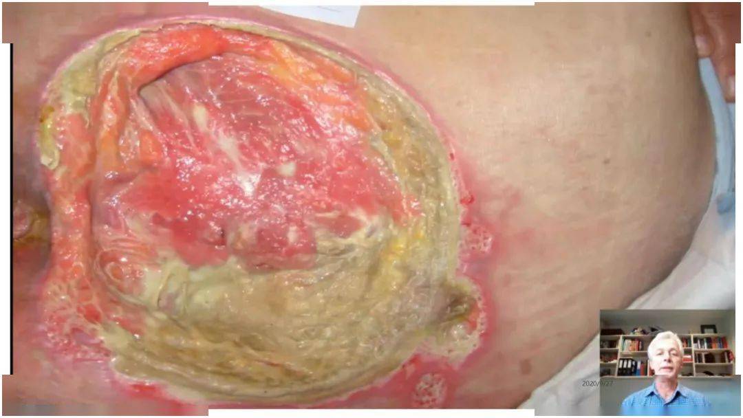 ppt2019国际压伤指南敷料应用的文献解读