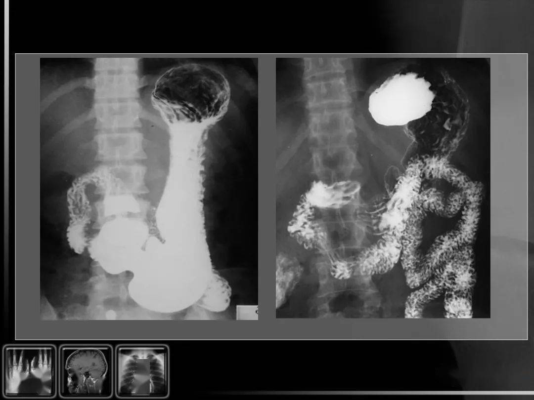 【汇总】消化道疾病影像诊断与鉴别_造影