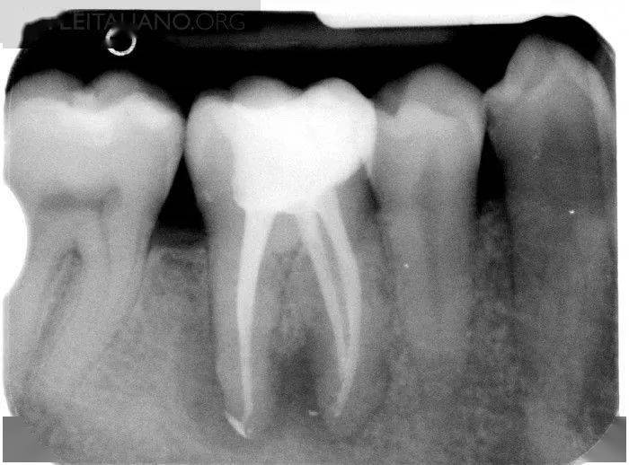 病例分享根管治疗诊间急症