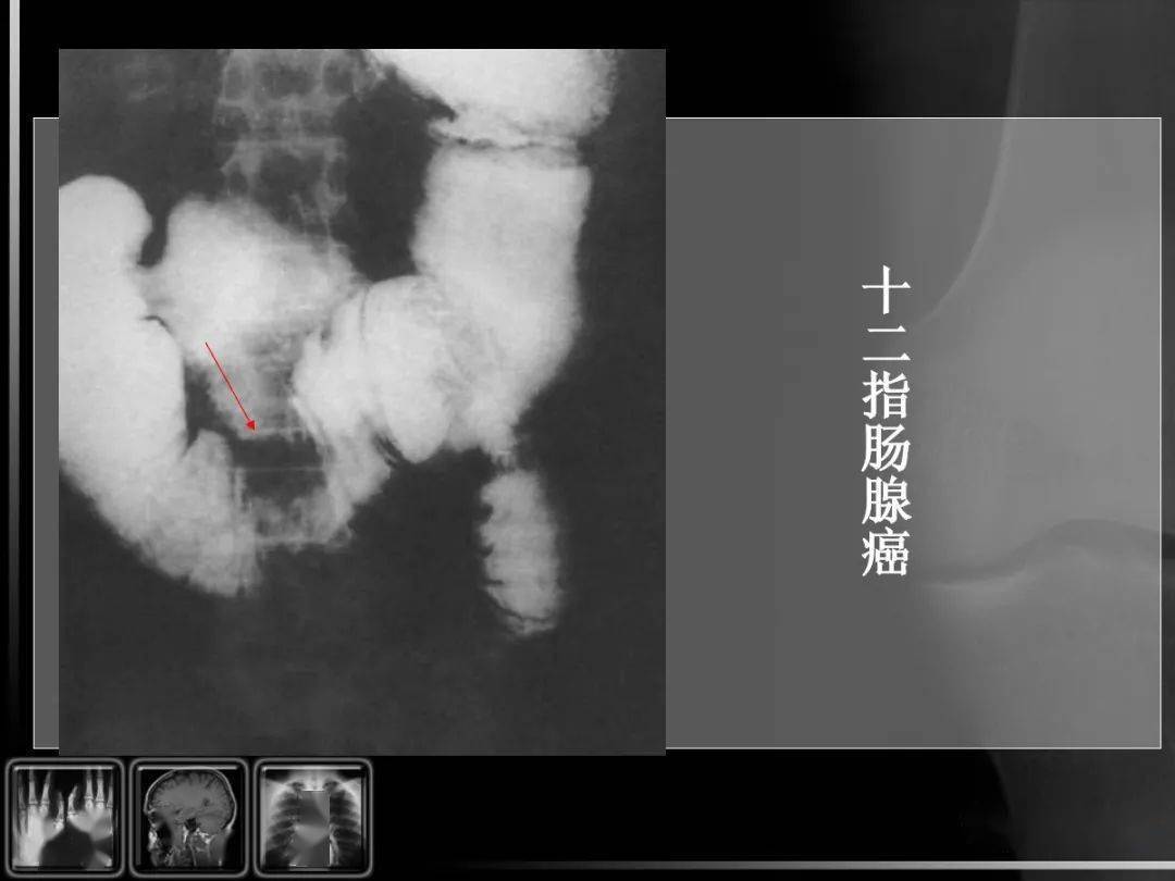 汇总消化道疾病影像诊断与鉴别