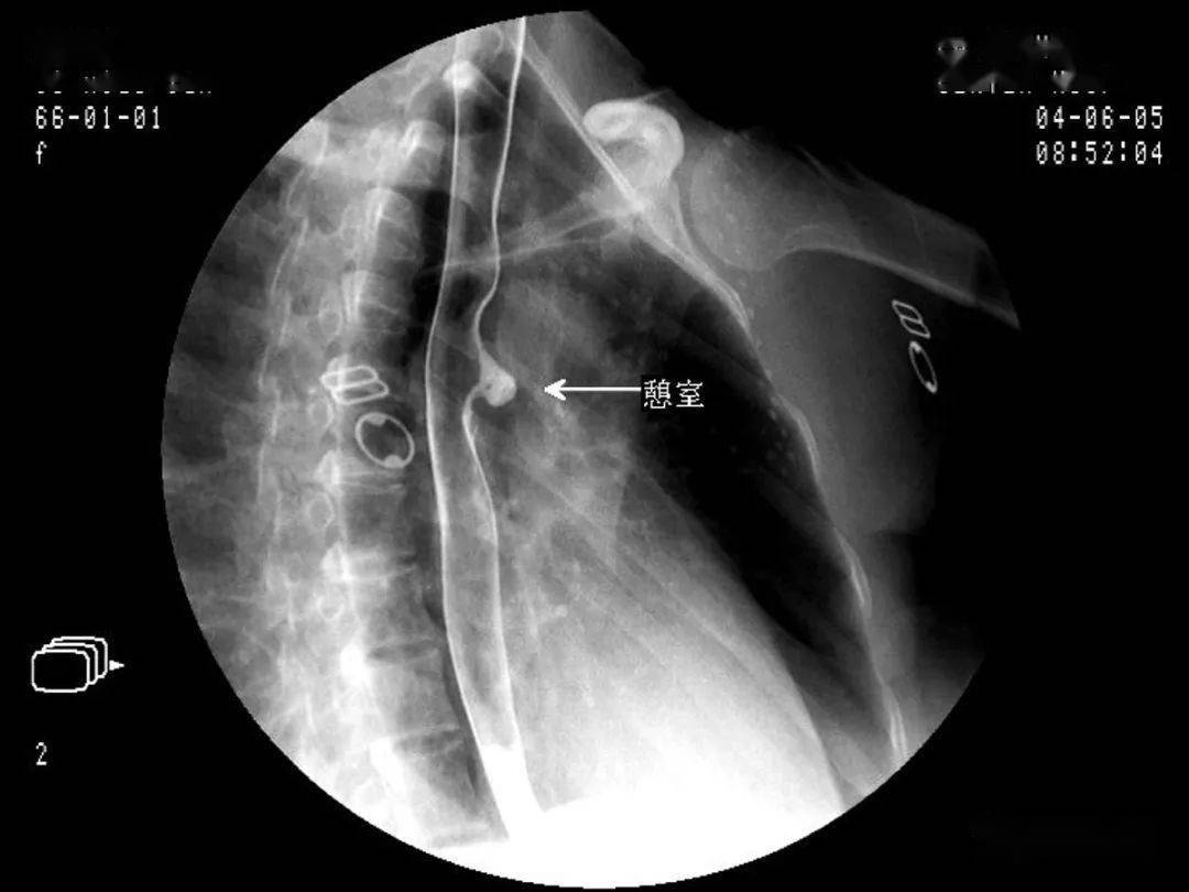 【汇总】消化道疾病影像诊断与鉴别_造影