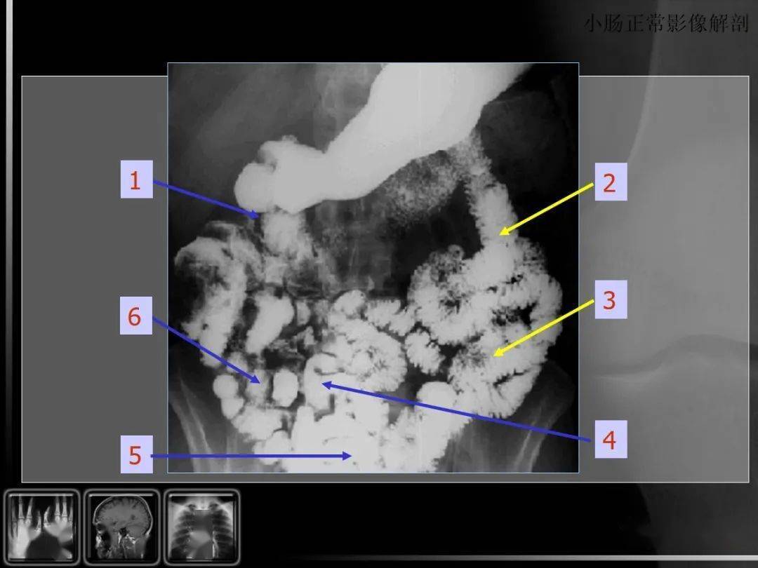 汇总消化道疾病影像诊断与鉴别