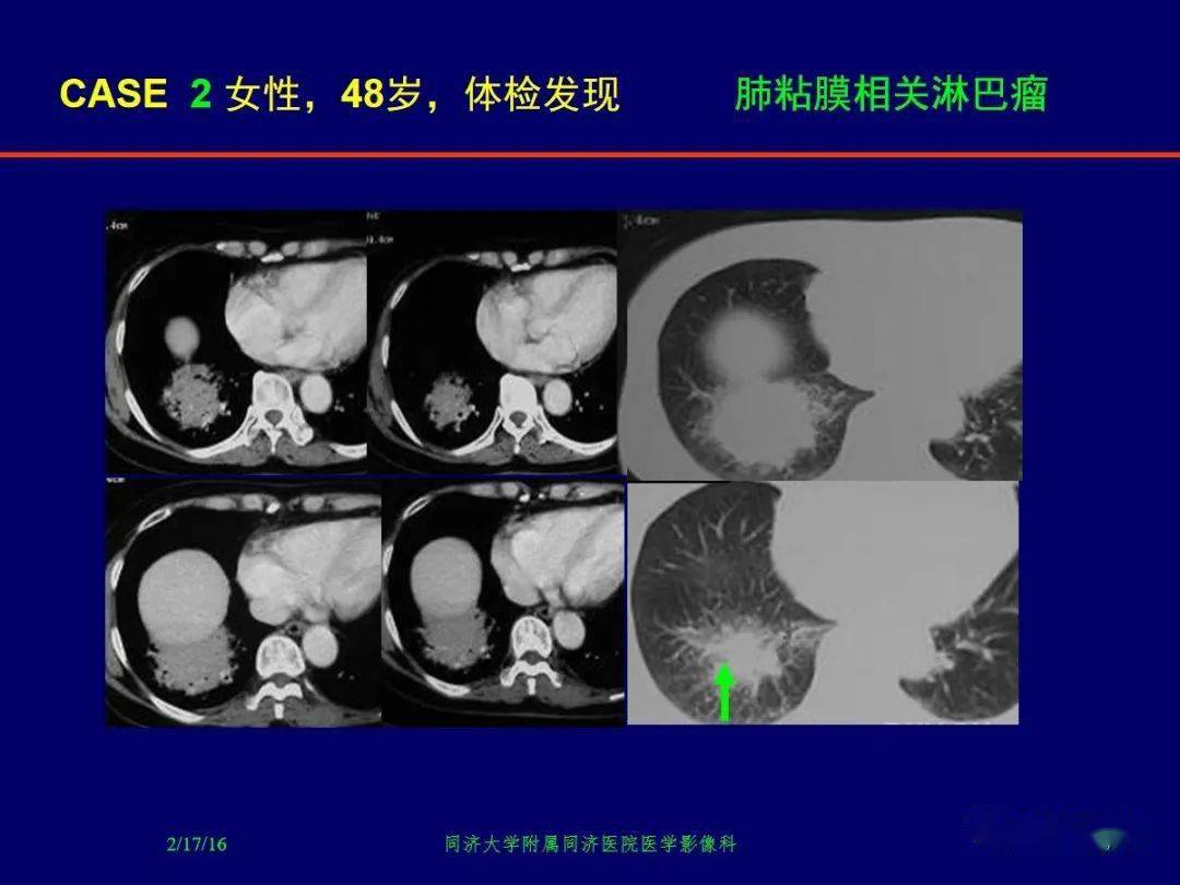 肺粘膜相关淋巴瘤影像诊断