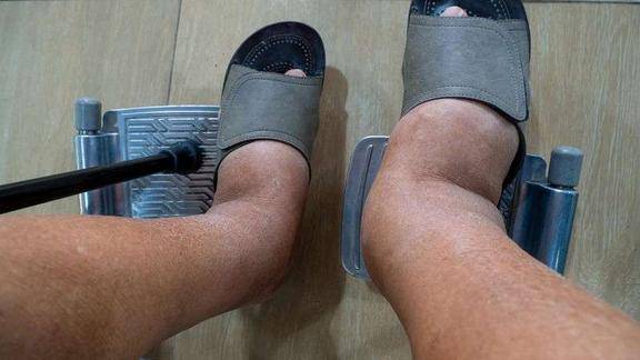 双下肢莫名浮肿或是这2类病症在捣鬼得及时检查了