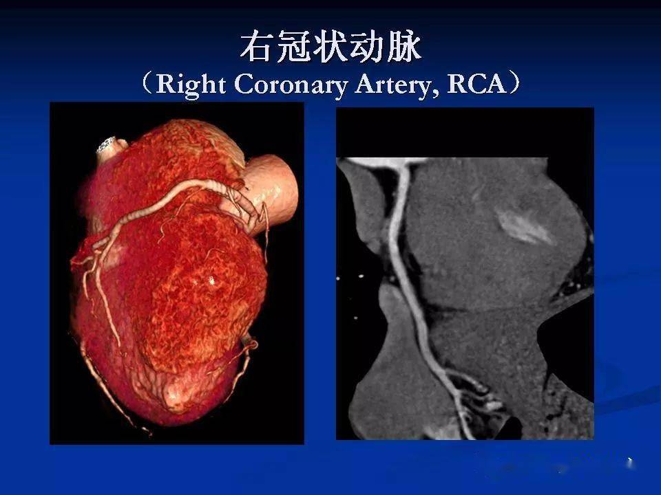 详细解读冠状动脉及冠心病ct