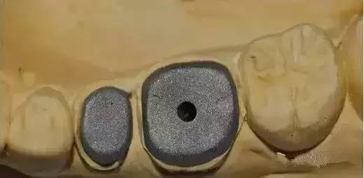 牙医必知丨临床上最容易忽略的技术之一