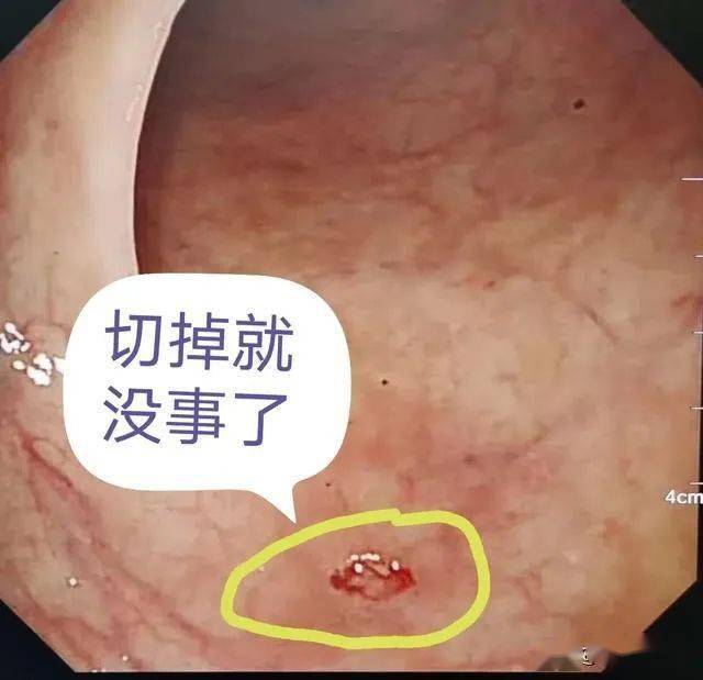 40歲前無症狀做一次腸鏡可以最大限度躲過腸癌