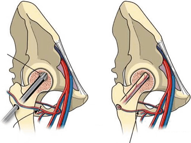 股骨頭壞死治療方法怎麼選一篇告訴你答案