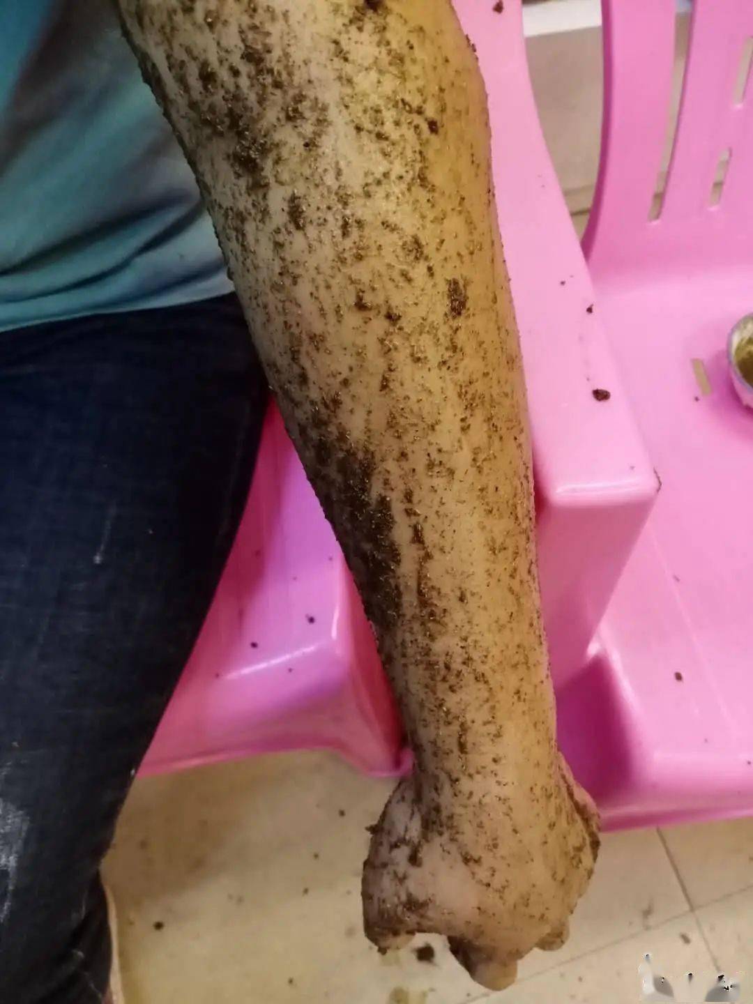 一女子被竹叶青咬伤手肿成这样