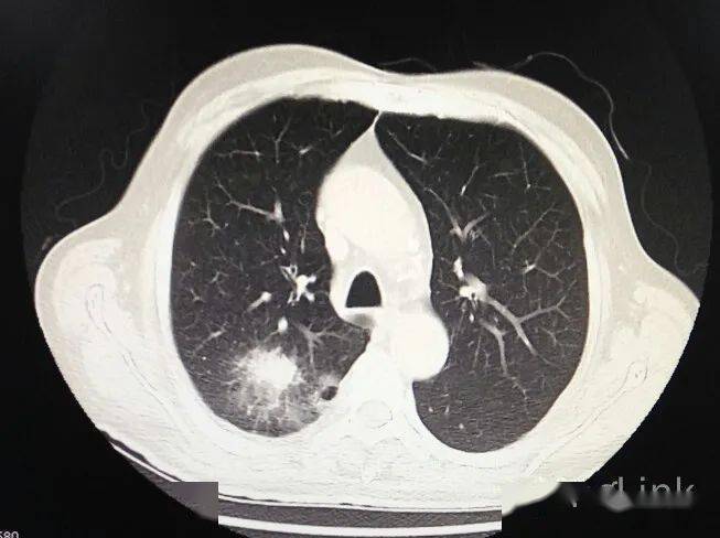 肺部有空洞是肺癌吗？