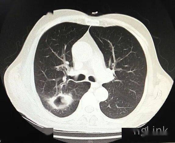 空洞型肺癌_手机搜狐网
