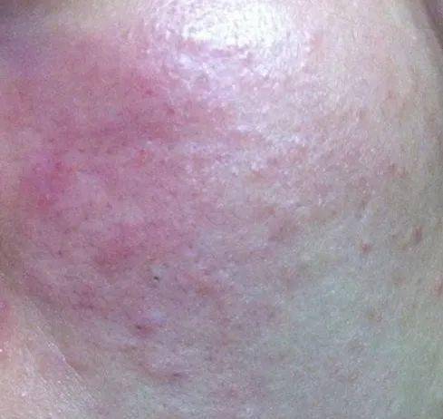 换季皮肤过敏不可怕掌握它重焕健康光泽肌