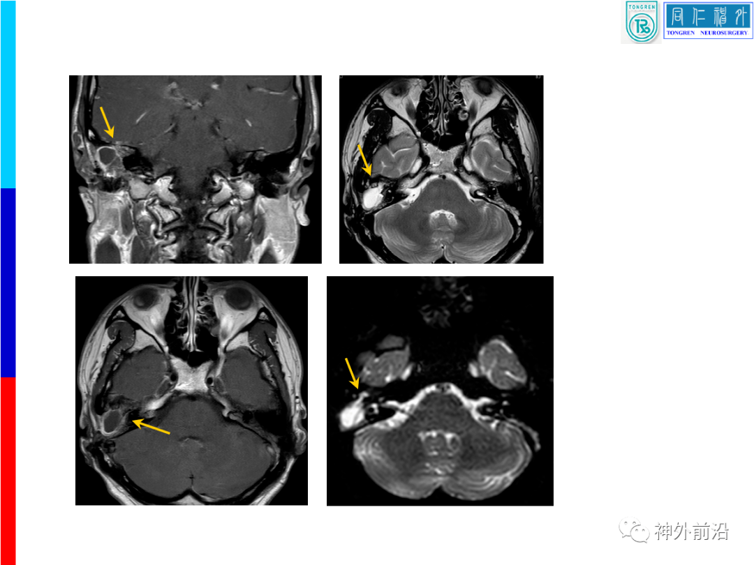 同仁颅面创伤容易误诊的脑脊液耳漏如何手术治疗康军