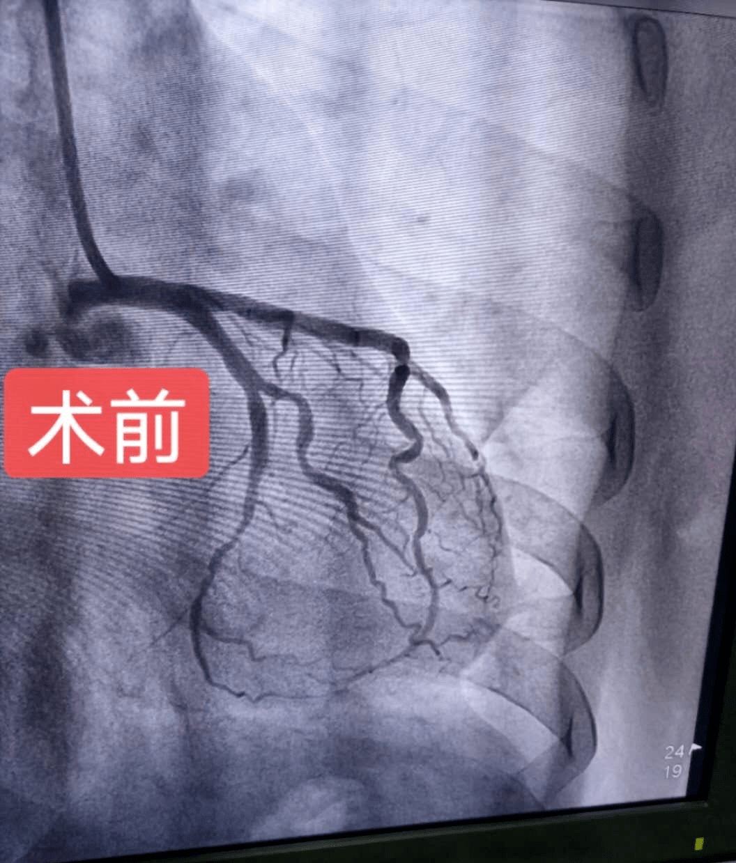 心脏回旋支无法放支架图片