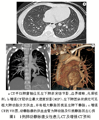 ct影像学上,pavm病灶可见供血动脉及引流静脉