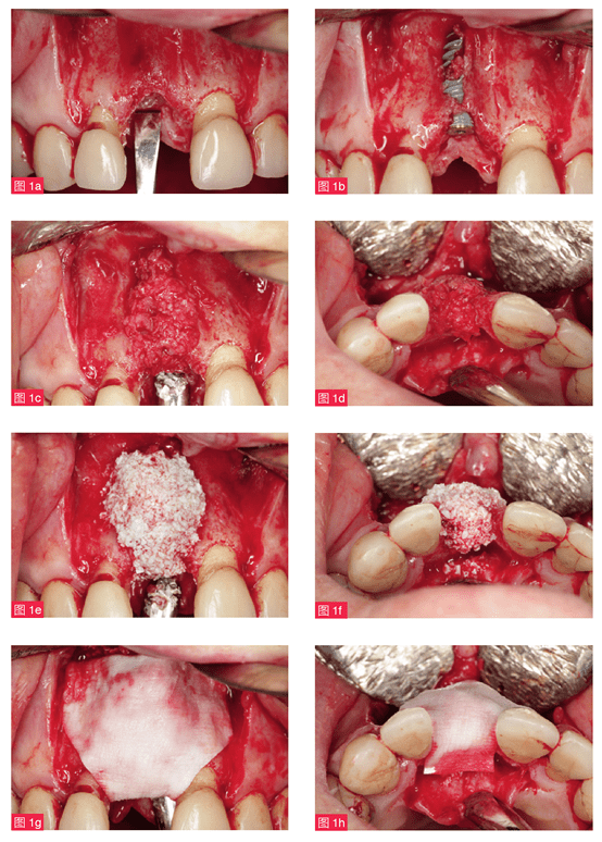 骨膜垂直褥式缝合在植骨中的应用istvanaurban教授王鸿烈教授
