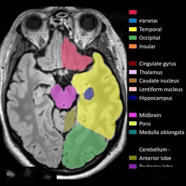 解剖丨脑叶分布(mri图像彩色标注)_lobes