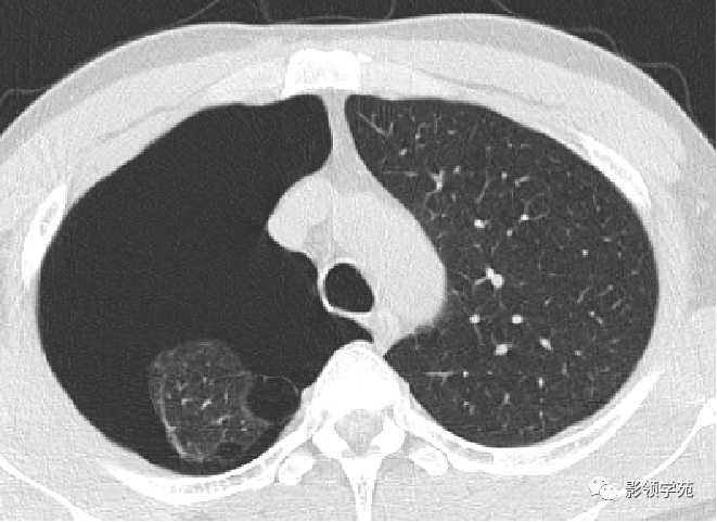 肺大泡x线图片