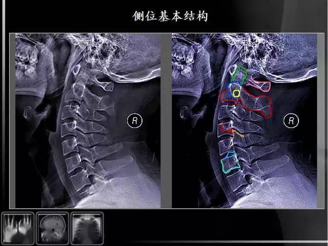 颈椎x线解剖图高清图片