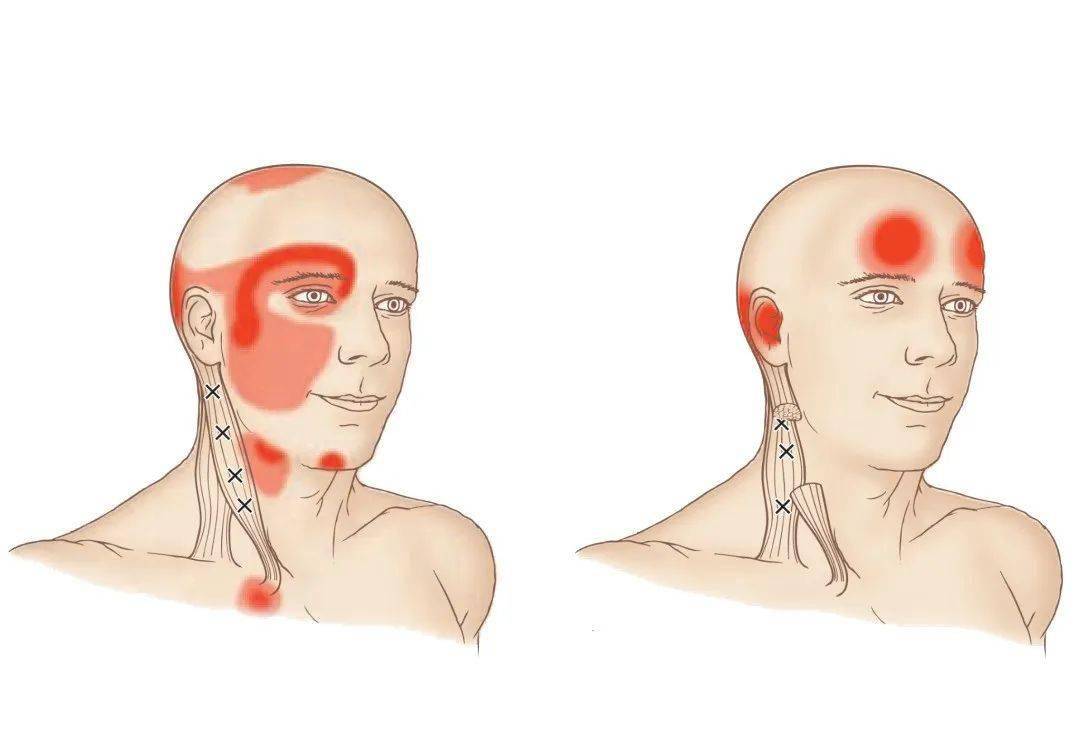 前额疼痛的四块肌肉
