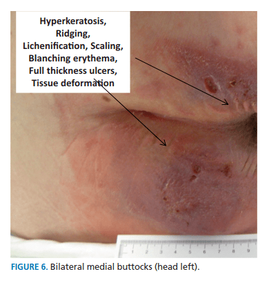 图6臀部双侧内部角化过度,苔藓样硬化,鳞片,指压变白红斑,全层溃疡