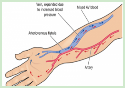 又可以分为两种:没有人工血管的称为自体动静脉内瘘(avf)有人工血管的