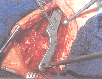 肩锁关节脱位3个步骤9种治疗方法